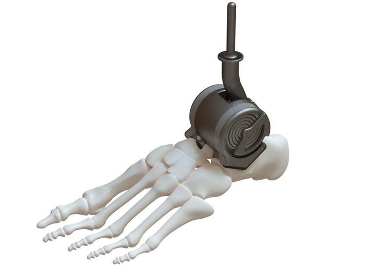 Ankle Implant Rendering