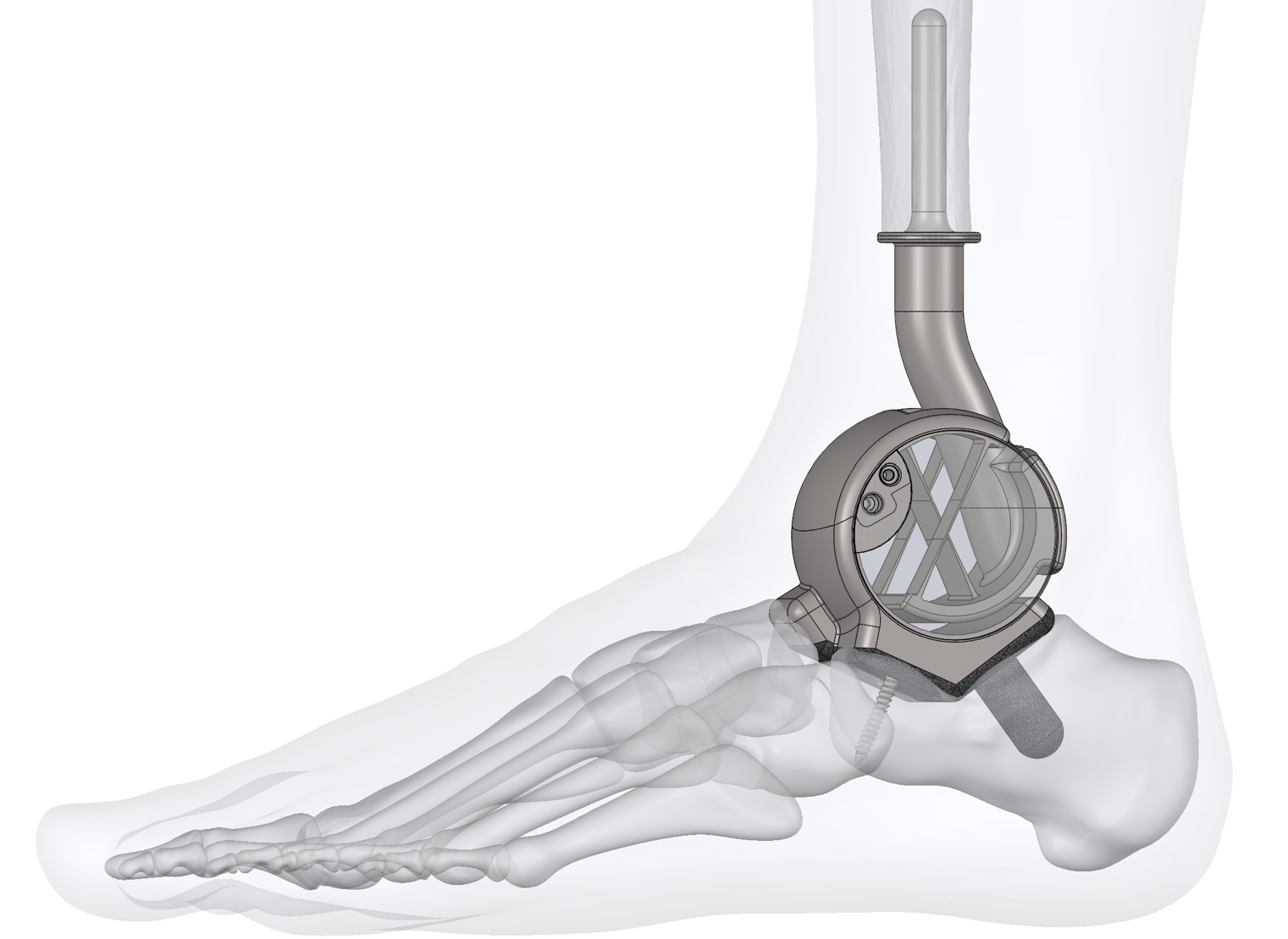Ankle Implant Rendering