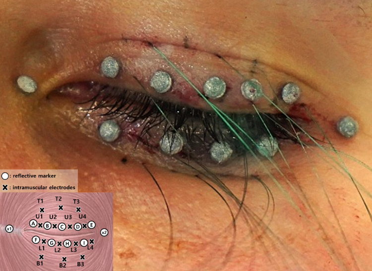Orbicularis oculi activation patterns