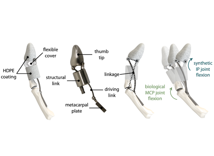 Thumb Implant