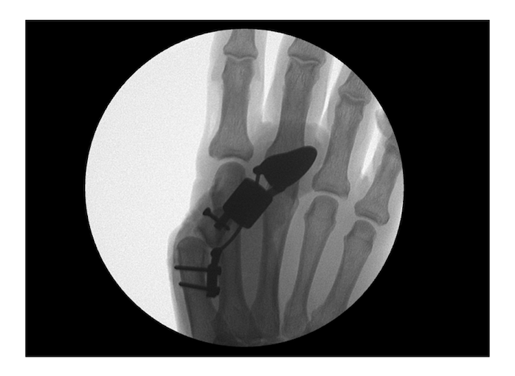 Thumb Implant Xray in Cadaver