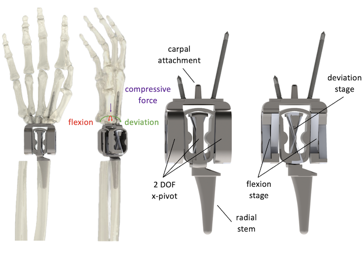 Rendering of implant in wrist
